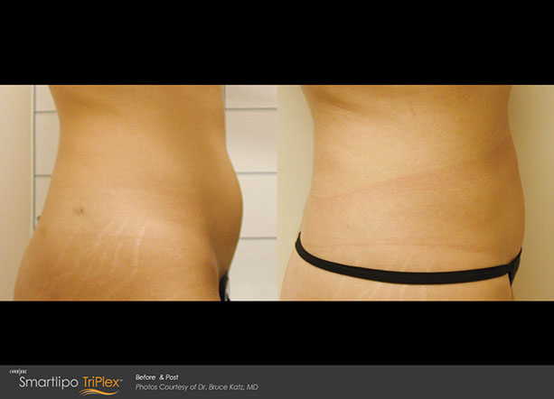 before and after smartlipo